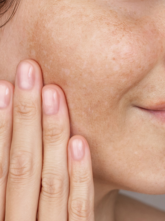 SKIN PIGMENTATION ISSUES