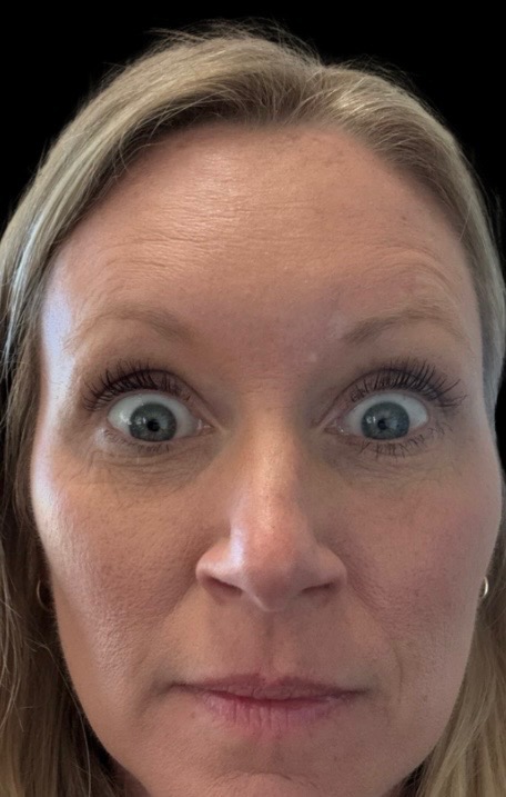 Botox Results - BeePure Aesthetics - After - 1