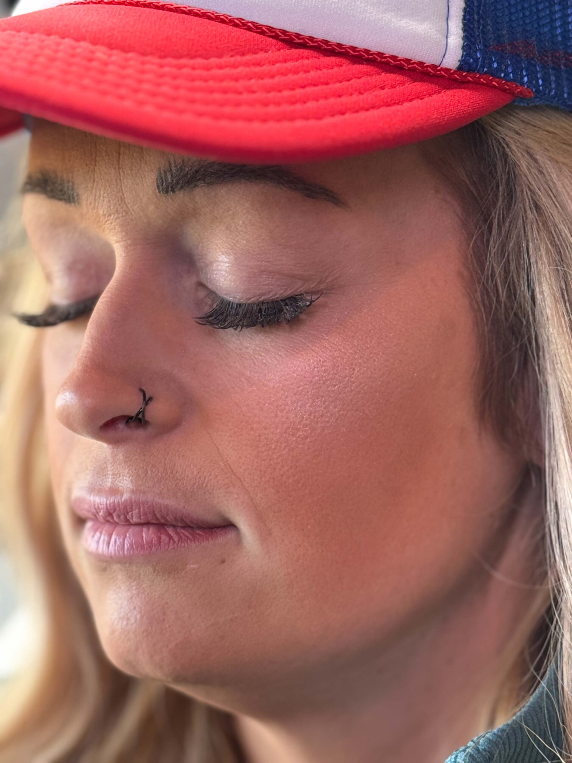 Lip Filler Results - BeePure Aesthetics - Before - 1