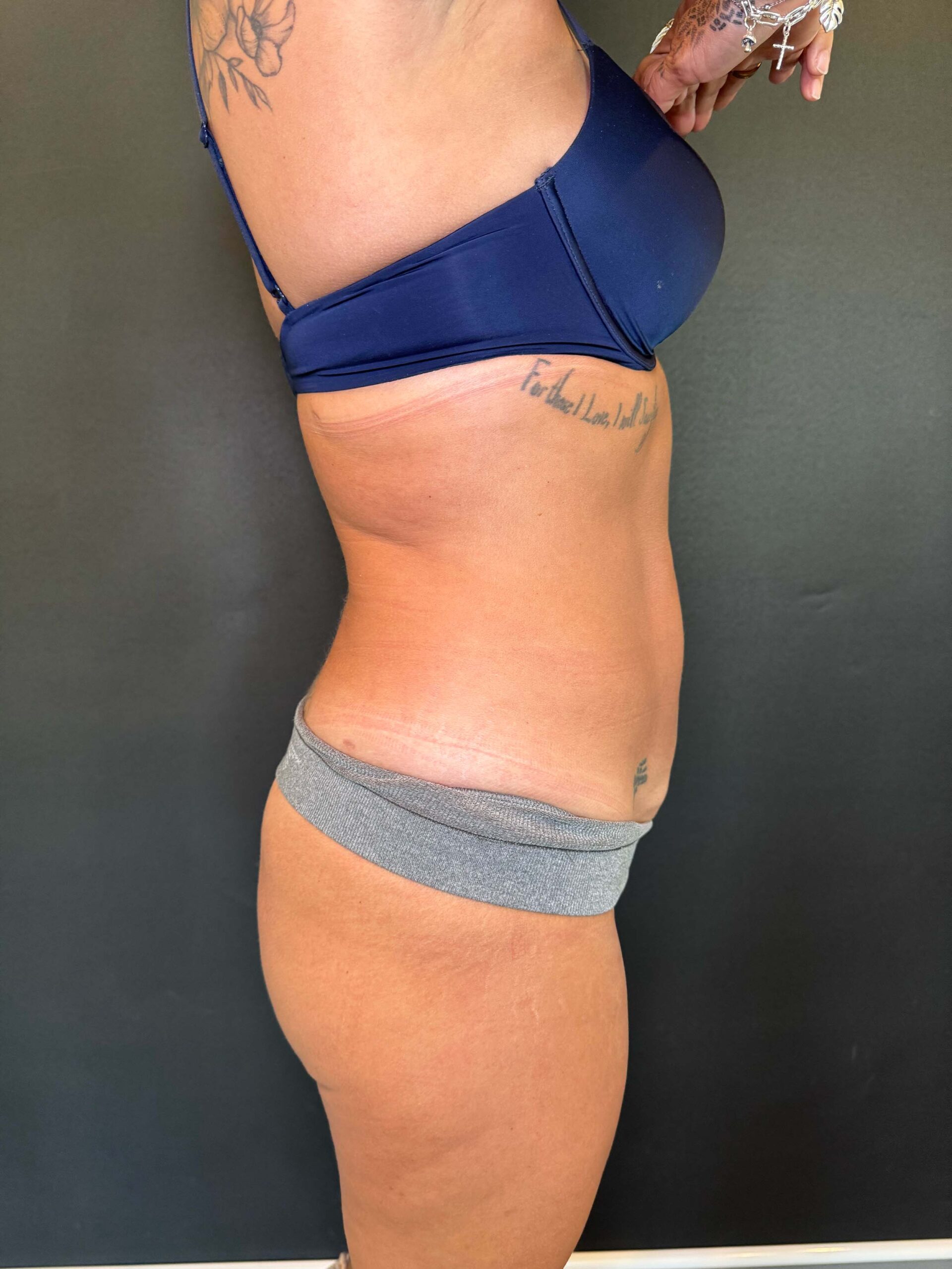 Liposuction Results - BeePure Aesthetics - After - 2