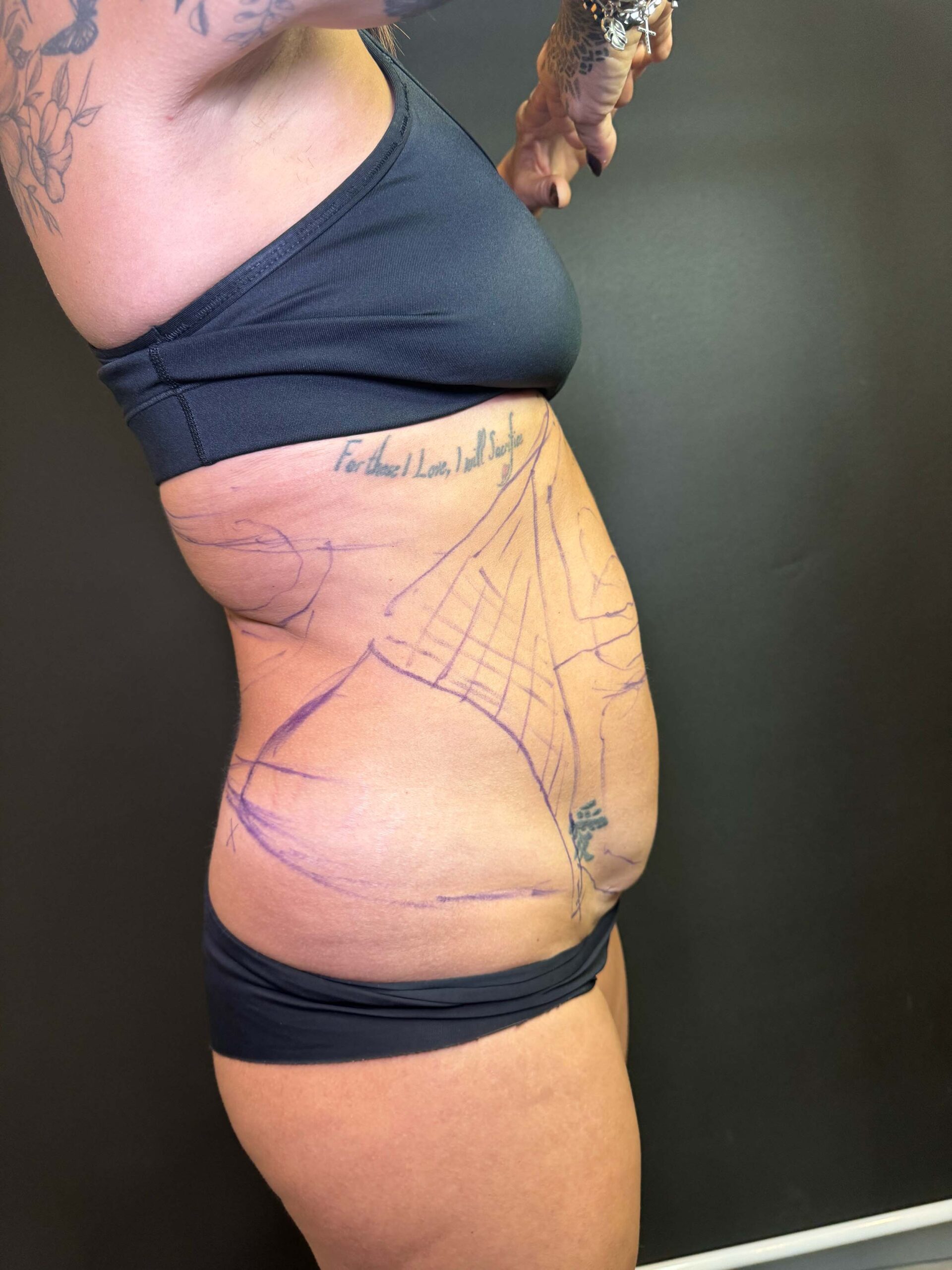 Liposuction Results - BeePure Aesthetics - Before - 2